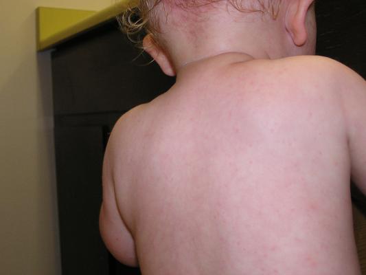 Noah has a rash.