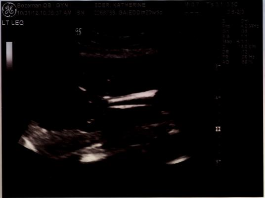 Ultrasound left leg