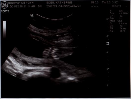 Ultrasound foot