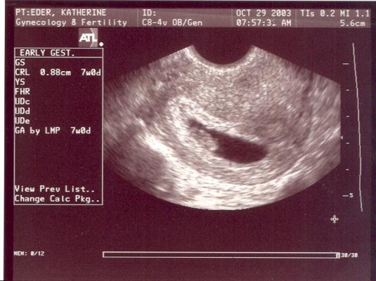 Here is our tiny baby. At 7 weeks he is fed by a yoke sack because the placenta has not yet developed.
